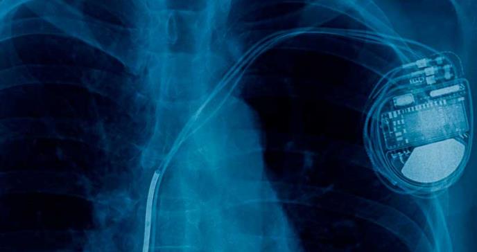 Marcapasos remoto ayudaría a pacientes cardíacos a evitar ingresos hospitalarios